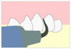 ① 歯石・歯垢除去