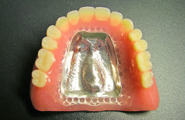 金属床義歯